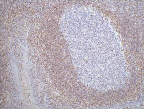 IHC staining of Human tonsil tissue paraffin-embedded with Bcl-2 mouse mAb (6B5) diluted at 1:200.
