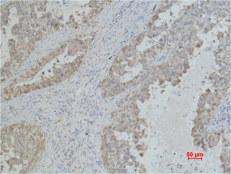 Immunohistochemical analysis of paraffin-embedded Human Lung caricnoma using HSP70 (EM1042) Mouse mAb diluted at 1:500.