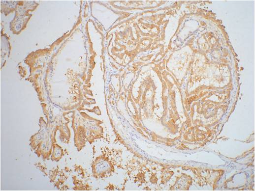IHC staining of Human thyroid tissue paraffin-embedded with Galectin-3 mouse mAb (6G2) diluted at 1:200.