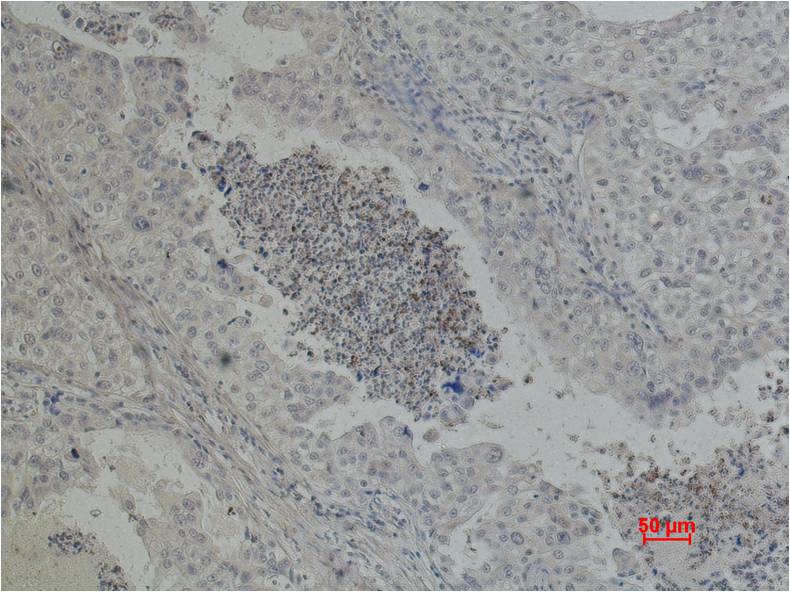 Immunohistochemical analysis of paraffin-embedded Human Lung caricnoma using EGFR (EM1044) Mouse mAb diluted at 1:500.