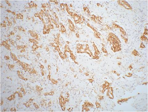 IHC staining of mouse prostate adenocarcinoma tissue with AMACR/P504S mouse mAb(4A12) diluted at 1:200.