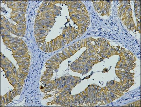 IHC staining of human colon cancer tissue with CK8 mouse mAb(8G8) diluted at 1:200.