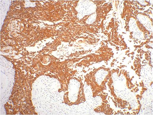 IHC staining of human gullet cancer tissue with CK16 mouse mAb(6F6) diluted at 1:200.