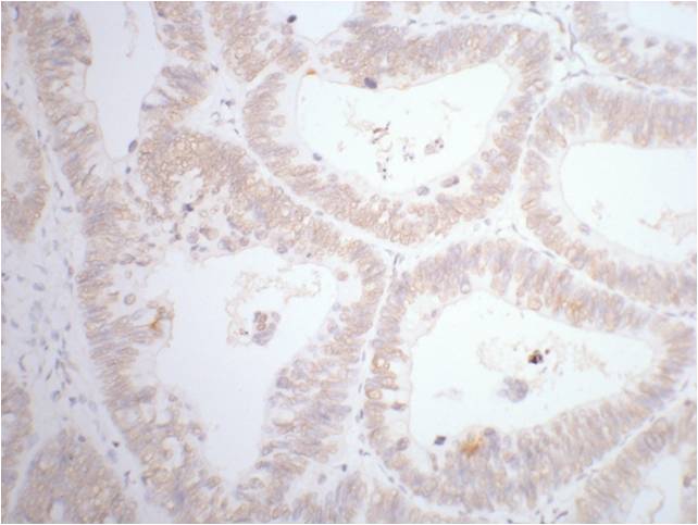 IHC staining of human rectal cancer tissue with CDX2 mouse mAb(14H6) diluted at 1:200.