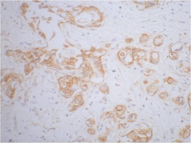 IHC staining of human breast cancer tissue with Beta-Catenin mouse mAb(13C6) diluted at 1:200.