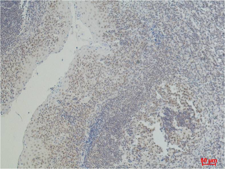 Immunohistochemical analysis of paraffin-embedded Human Tonsil Caricnoma using CD2 (EM1069) Mouse mAb diluted at 1:500.