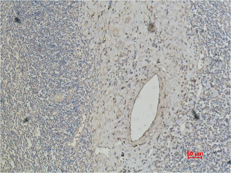Immunohistochemical analysis of paraffin-embedded Human Tonsil Caricnoma using CD4 (EM1070) Mouse mAb diluted at 1:200.