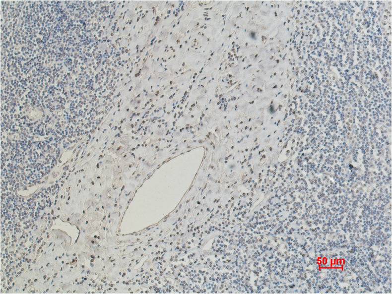 Immunohistochemical analysis of paraffin-embedded Human Tonsil Caricnoma using CD5 (EM1071) Mouse mAb diluted at 1:200.