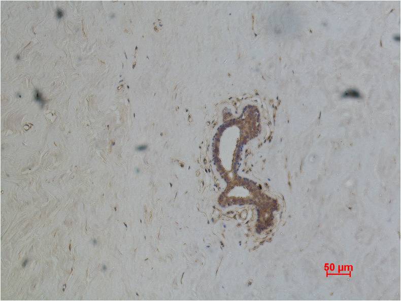 Immunohistochemical analysis of paraffin-embedded Human Breast Caricnoma using ABCB5 (EM1074) Mouse mAb diluted at 1:500.