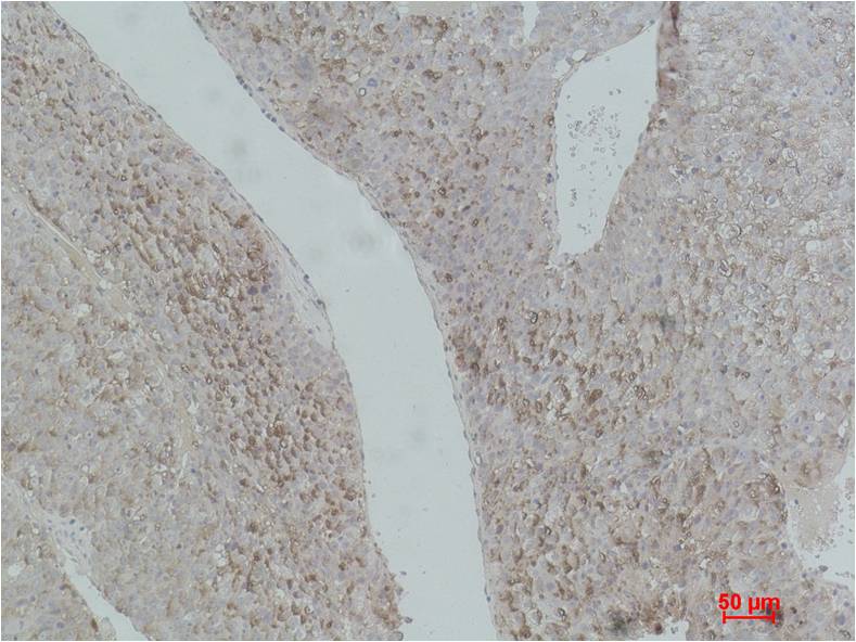 Immunohistochemical analysis of paraffin-embedded Human Hepatocaricnoma using AFP (EM1075) Mouse mAb diluted at 1:500.