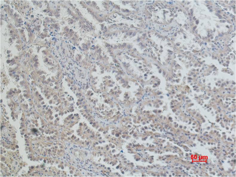 Immunohistochemical analysis of paraffin-embedded Human Lung Caricnoma using ERCC1 (EM1078) Mouse mAb diluted at 1:200.