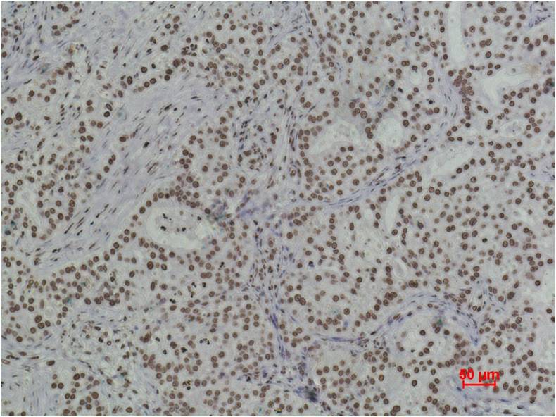 Immunohistochemical analysis of paraffin-embedded Human Breast Caricnoma using Histone H3(di methyl K79) (EM1087) Mouse mAb diluted at 1:500.