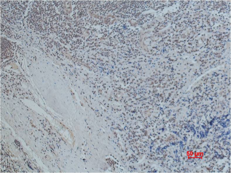 Immunohistochemical analysis of paraffin-embedded Human Tonsil Caricnoma using Oct1 (EM1089) Mouse mAb diluted at 1:500.