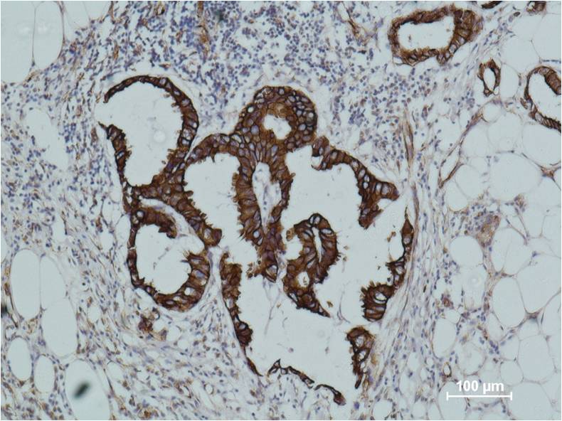 Immunohistochemical analysis of paraffin-embedded human breast caricnoma using Cytokeratin 18 (EM1095) Mouse mAb diluted at 1:500.