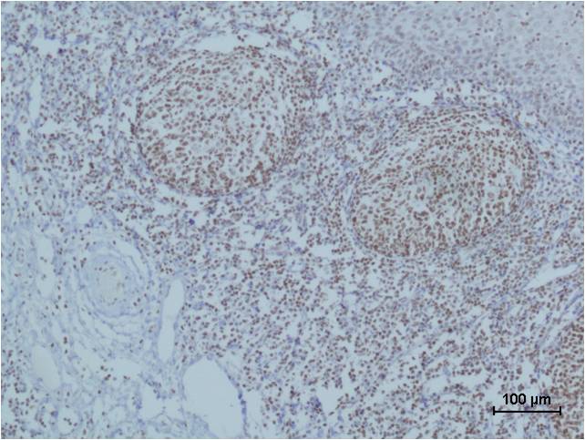 Immunohistochemical analysis of paraffin-embedded human Tonsil Tissue using Cleaved PARP (EM1132) Mouse mAb diluted at 1:500.