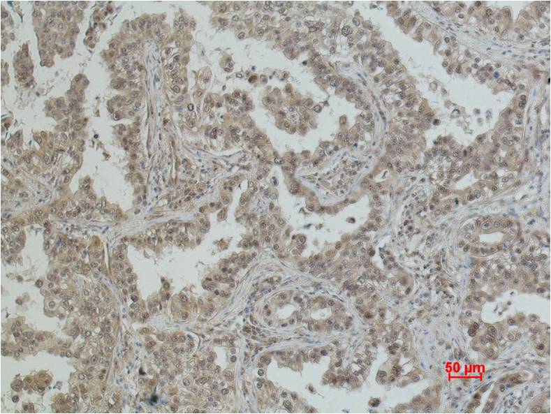 Immunohistochemical analysis of paraffin-embedded Human Lung Caricnoma using eIF4A1 (EM1136) Mouse mAb diluted at 1:200.