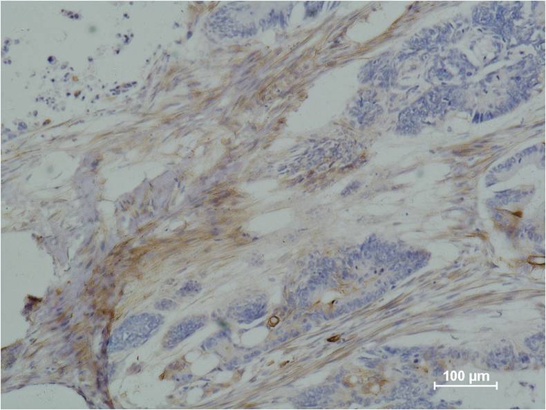 Immunohistochemical analysis of paraffin-embedded human Colon caricnoma using b III tubulin (EM1166) Mouse mAb diluted at 1:500.