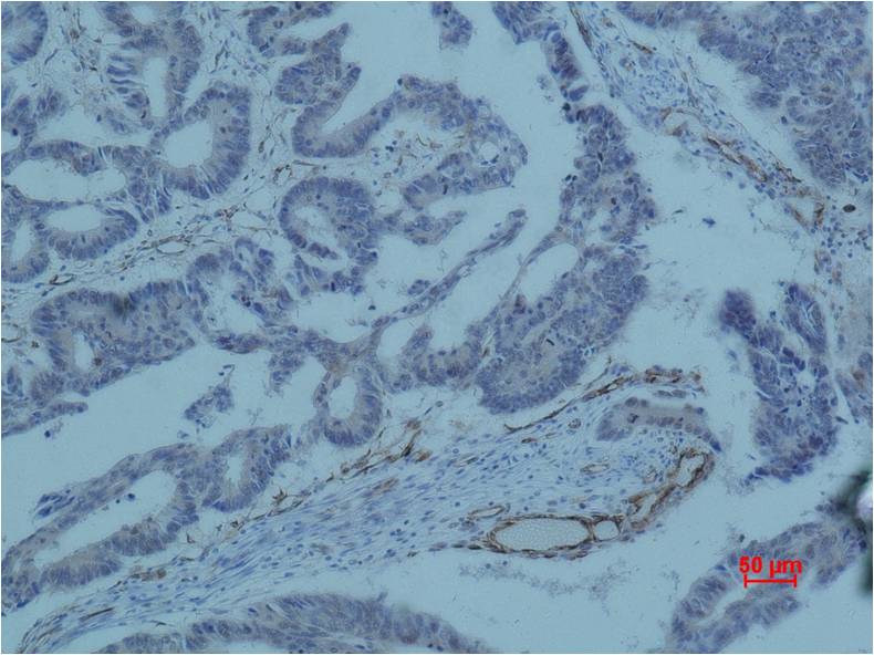 Immunohistochemical analysis of paraffin-embedded human colon caricnoma using Survivin (EM1184) Mouse mAb diluted at 1:500.