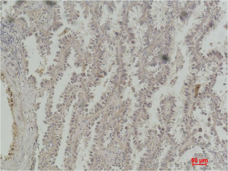 Immunohistochemical analysis of paraffin-embedded Human Lung Carcinoma using CREB (EM1185) Mouse mAb diluted at 1:200.