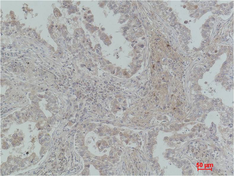 Immunohistochemical analysis of paraffin-embedded Human Lung Carcinoma using CBARA1/MICU1 (EM1187) Mouse mAb diluted at 1:200.
