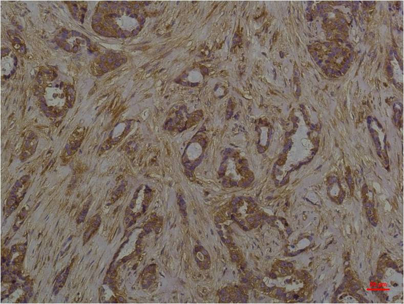 Immunohistochemical analysis of paraffin-embedded Human Breast Caricnoma using Phosphoserine (EM1189) Mouse mAb diluted at 1:200.
