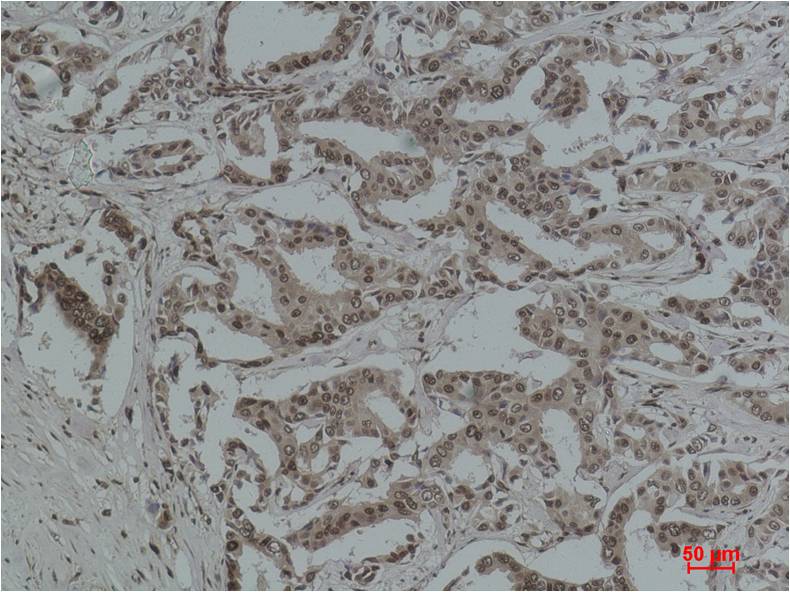 Immunohistochemical analysis of paraffin-embedded Human Breast Carcinoma using Aceylated Lysine (EM1191) Mouse mAb diluted at 1:500.