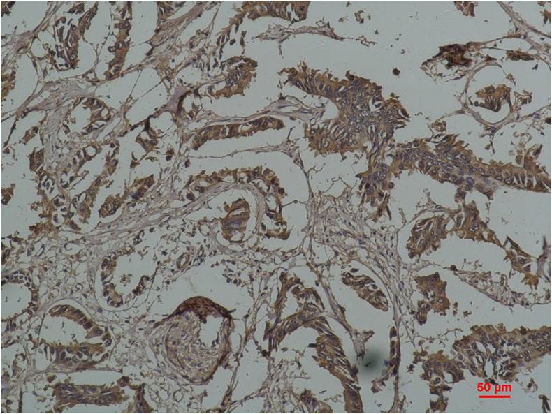 Immunohistochemical analysis of paraffin-embedded Human Breast Caricnoma using HSP27 (EM1192) Mouse mAb diluted at 1:200.
