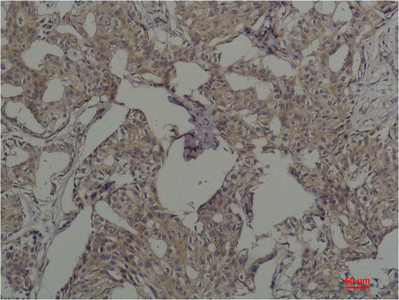 Immunohistochemical analysis of paraffin-embedded Human Breast Caricnoma using c-Fos (EM1193) Mouse mAb diluted at 1:200.