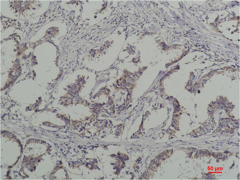 Immunohistochemical analysis of paraffin-embedded Human Breast Caricnoma using Phosphotyrosine (EM1194) Mouse mAb diluted at 1:200.