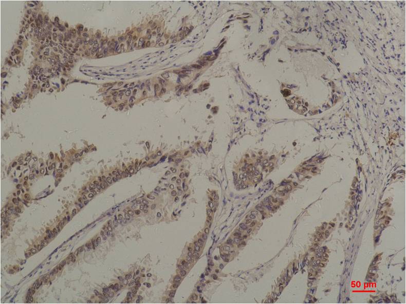 Immunohistochemical analysis of paraffin-embedded Human Breast Caricnoma using HSC70 (EM1200) Mouse mAb diluted at 1:200.