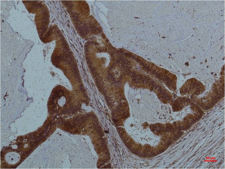 Immunohistochemical analysis of paraffin-embedded Human Colon Caricnoma using STAT3 (EM1207) Mouse mAb diluted at 1:200.
