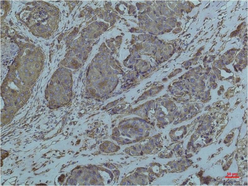 Immunohistochemical analysis of paraffin-embedded Human Breast Caricnoma using GRP78/Bip (EM1210) Mouse mAb diluted at 1:200.