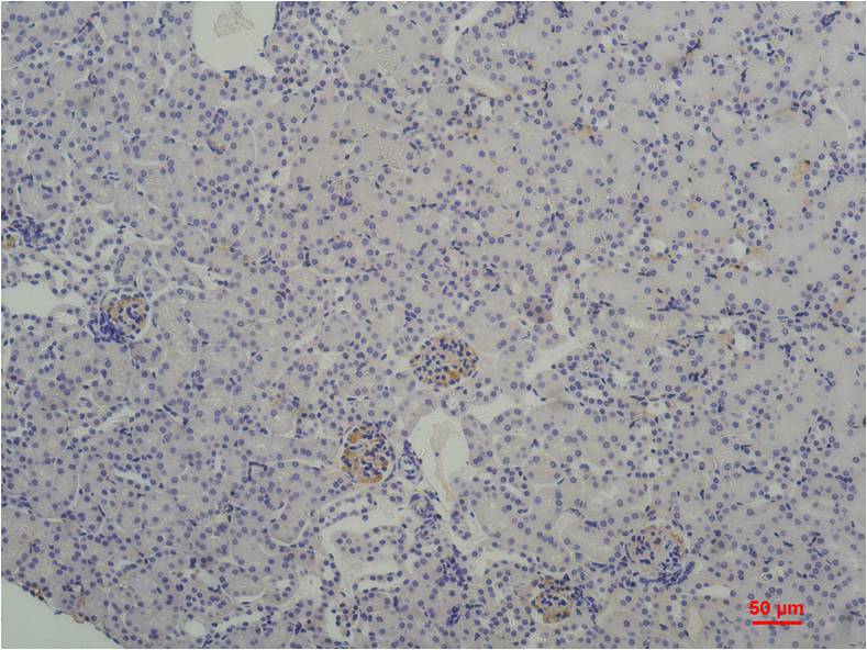 Immunohistochemical analysis of paraffin-embedded Human Breast Carcinoma using TBP/TATA Binding Protein (EM1220) Mouse mAb diluted at 1:200.
