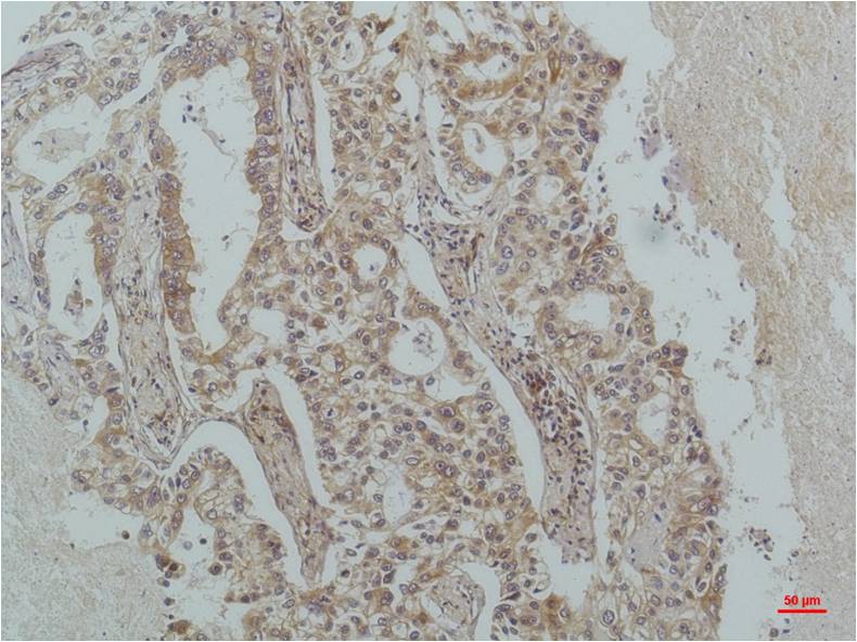 Immunohistochemical analysis of paraffin-embedded Human Lung Carcinoma using IκB Beta(EM1226)Mouse mAb diluted at 1:200.
