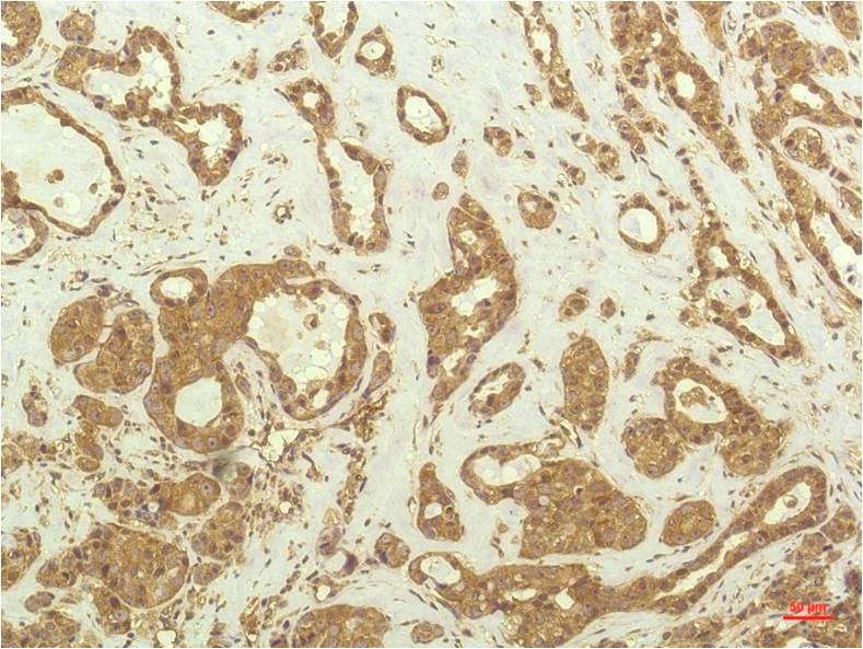 Immunohistochemical analysis of paraffin-embedded Human Breast Carcinoma Tissue using P70 S6 Kinase (EM1253) Mouse mAb diluted at 1:200.