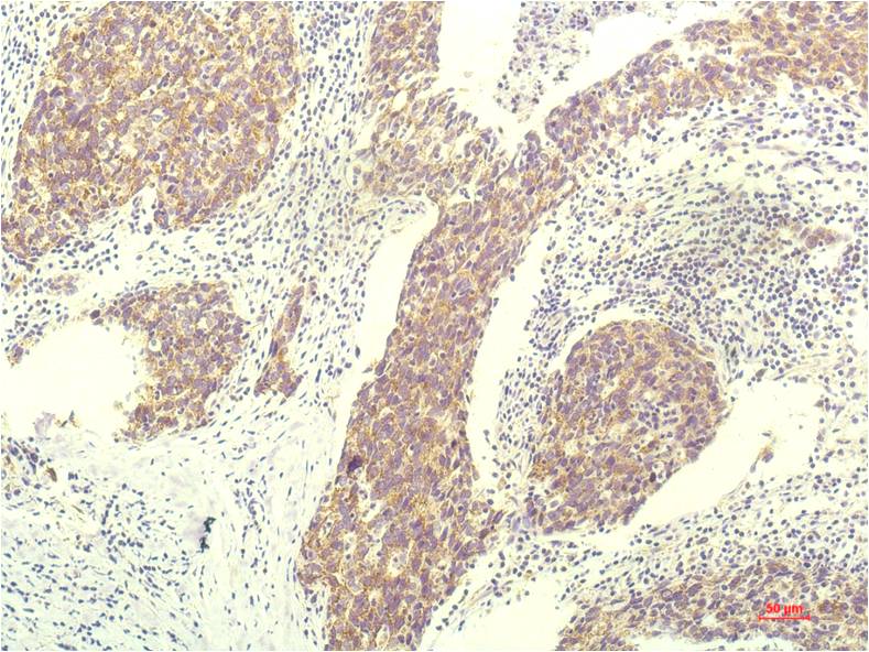 Immunohistochemical analysis of paraffin-embedded Human Breast Carrcinoma Tissue using STAT1 (EM1259) Mouse mAb diluted at 1:200.