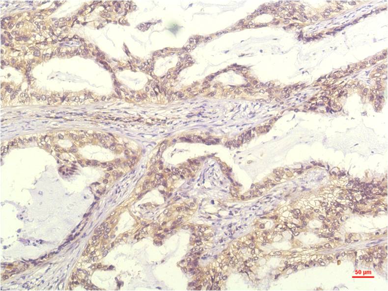 Immunohistochemical analysis of paraffin-embedded Human Lung Carrcinoma Tissue using IL-8 (EM1260) Mouse mAb diluted at 1:200.