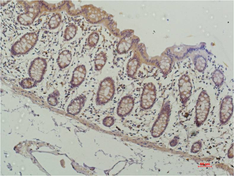 Immunohistochemical analysis of paraffin-embedded Human Colon Carcinoma Tissue using HADC1 (EM1265) Mouse mAb diluted at 1:200.