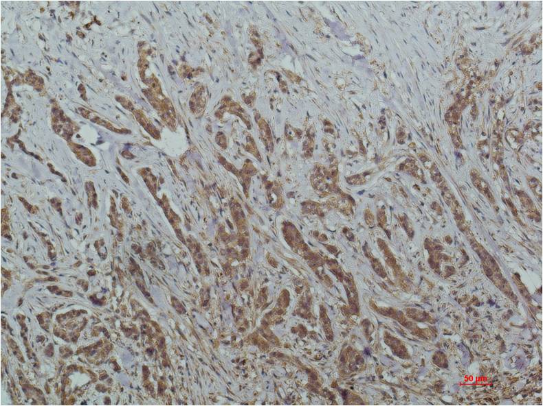 Immunohistochemical analysis of paraffin-embedded Human Breast Carcinoma Tissue using HADC1 (EM1265) Mouse mAb diluted at 1:200.