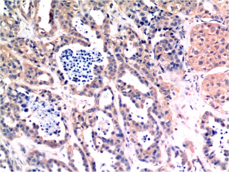 Immunohistochemical analysis of paraffin-embedded Human Breast Carcinoma Tissue using Bax (EM1268) Mouse mAb diluted at 1:200.