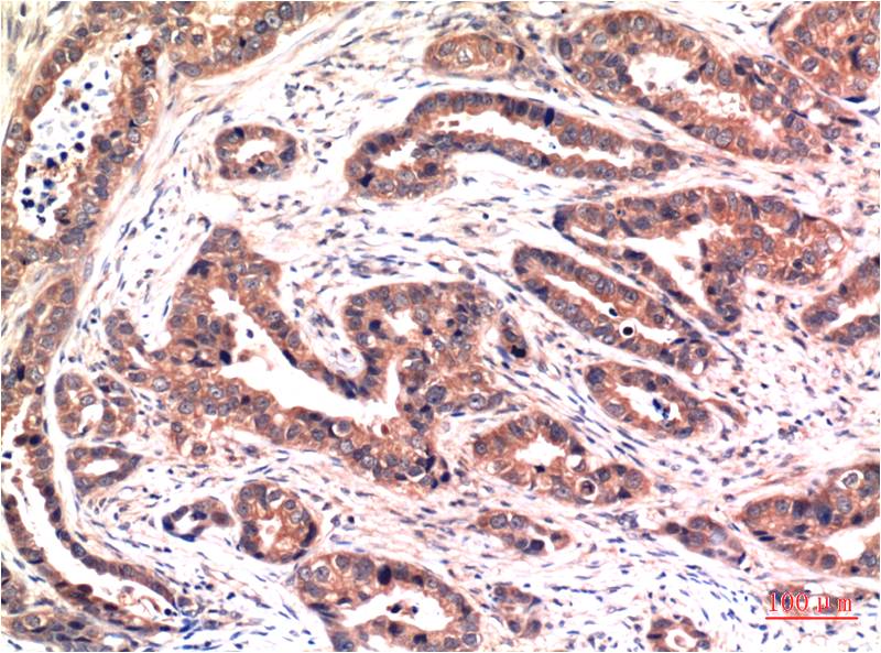 Immunohistochemical analysis of paraffin-embedded Human Breast Carcinoma Tissue using Phospho-Akt Ser473 (EM1269) Mouse mAb diluted at 1:200.