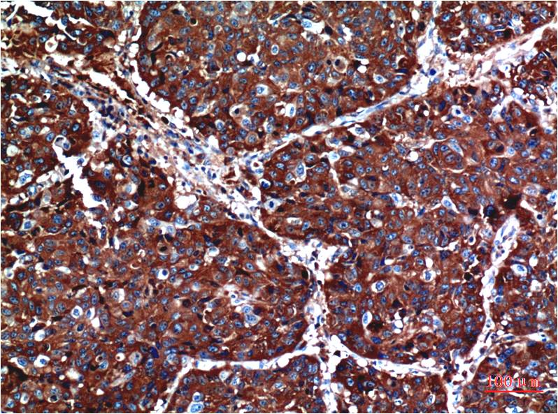 Immunohistochemical analysis of paraffin-embedded Human Lung Carcinoma Tissue using Akt (EM1271) Mouse mAb diluted at 1:200.