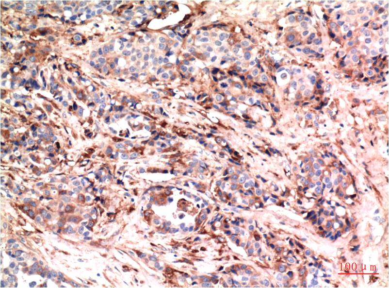Immunohistochemical analysis of paraffin-embedded Human Breast Carcinoma Tissue using Akt (EM1271) Mouse mAb diluted at 1:200.