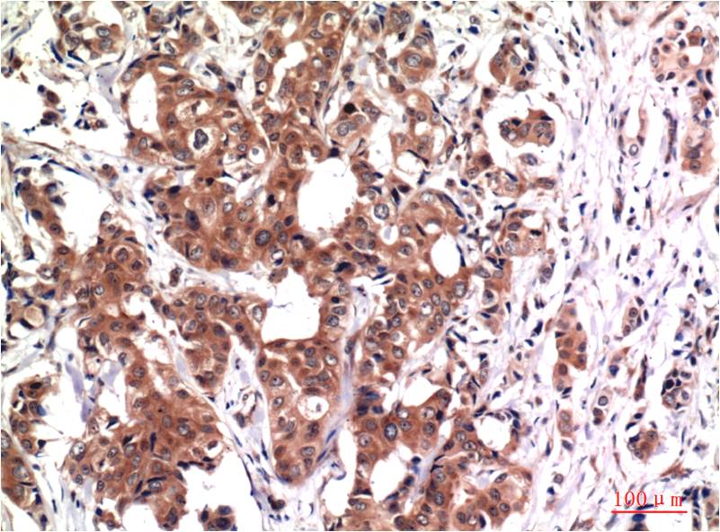 Immunohistochemical analysis of paraffin-embedded Human Breast Carcinoma Tissue using GSK3Beta (EM1283) Mouse mAb diluted at 1:200.