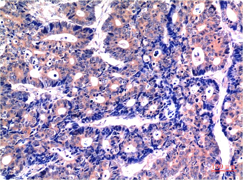 Immunohistochemical analysis of paraffin-embedded Human Stomach Carcinoma Tissue using GSK3Beta (EM1283) Mouse mAb diluted at 1:200.
