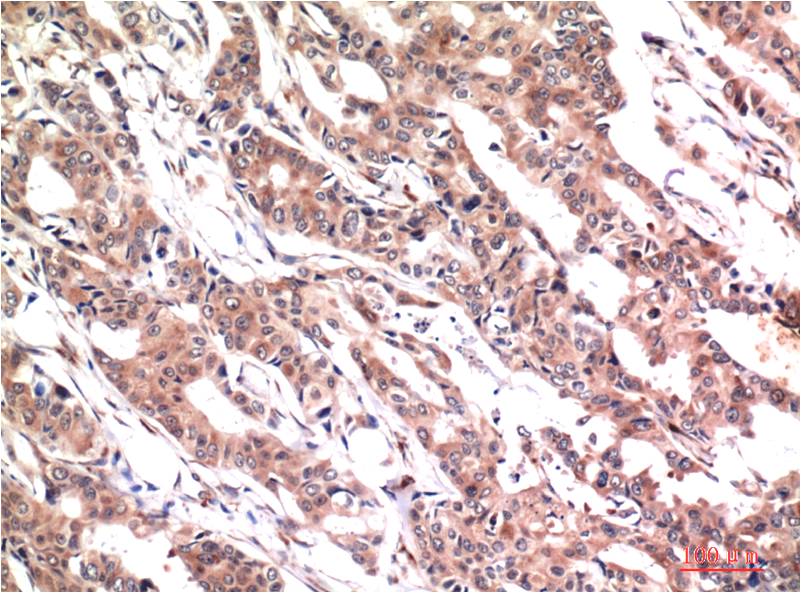 Immunohistochemical analysis of paraffin-embedded Human Breast Carcinoma Tissue using phospho-Stat3 Y705 (EM1290) Mouse mAb diluted at 1:200.