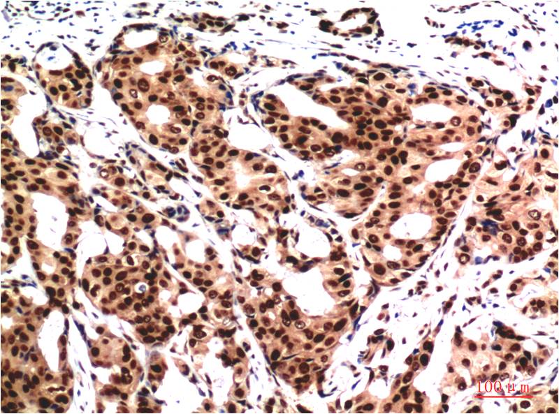 Immunohistochemical analysis of paraffin-embedded Human Breast CarcinomaTissue using Ubiquitin (EM1296) Mouse mAb diluted at 1:200.