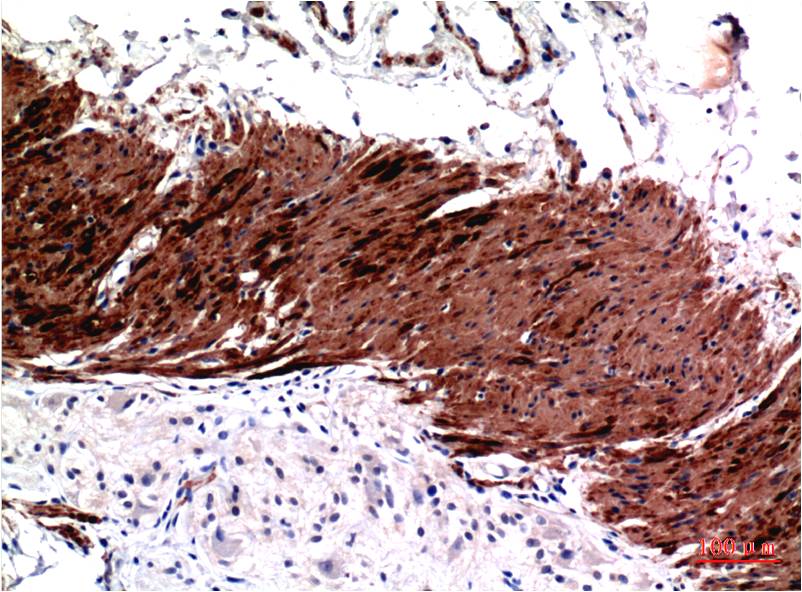 Immunohistochemical analysis of paraffin-embedded Human Colon Carcinoma Tissue using Muscle Actin (EM1297 ) Mouse mAb diluted at 1:200.