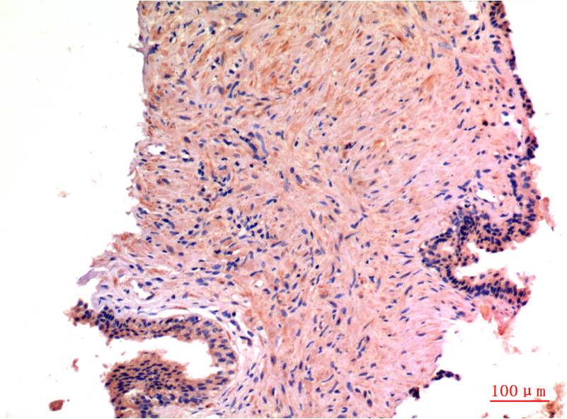 Immunohistochemical analysis of paraffin-embedded Human Prostate Carcinoma Tissue using LC3A (EM1298 ) Mouse mAb diluted at 1:200.