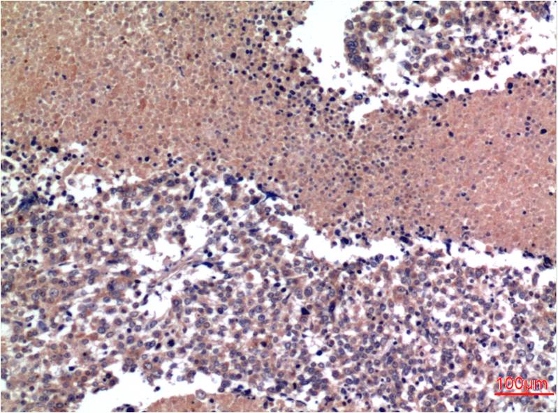 Immunohistochemical analysis of paraffin-embedded Human Lung Carcinoma Tissue using Cyclin B1 (EM1299) Mouse mAb diluted at 1:200.